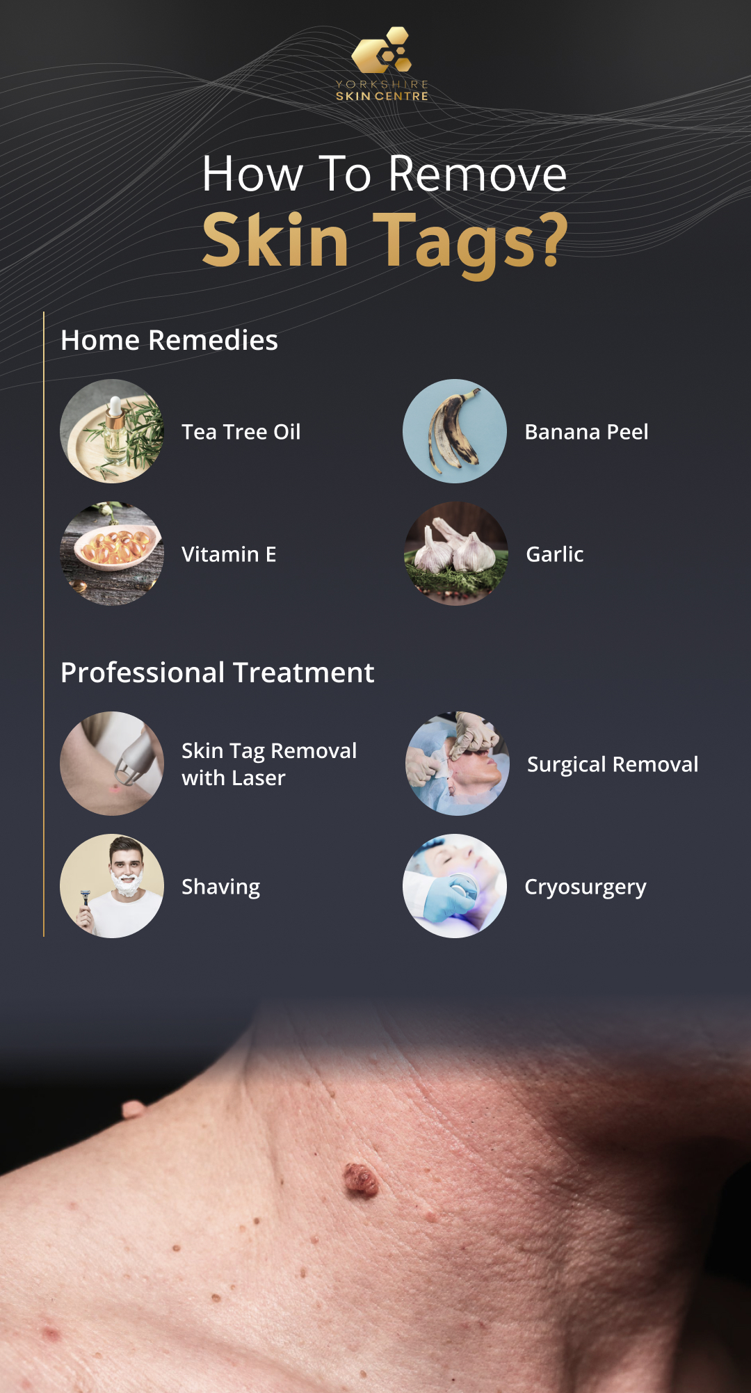 How To Remove  Skin Tags